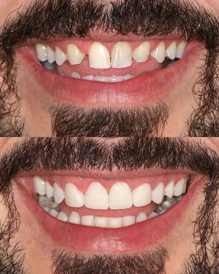 Before and after dental transformation