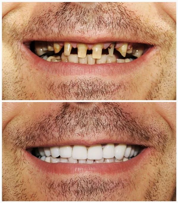 Before and after dental transformation